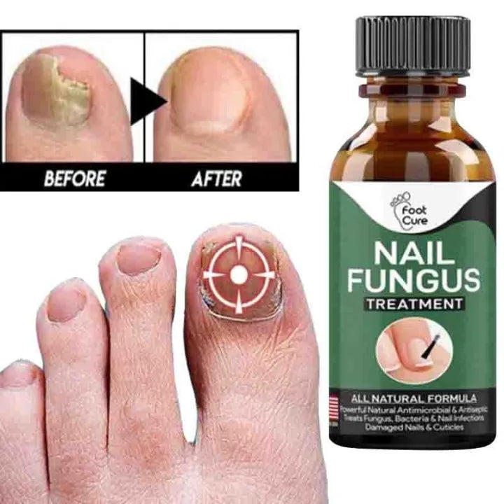 Nail Fungal Repair Serum | Nail Fungus Removal Serum