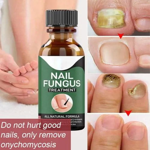 Nail Fungal Repair Serum | Nail Fungus Removal Serum